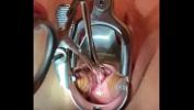 Watch video sex Sound tenaculum applying traction to cervix Mp4 - TubeXxvideo.Com