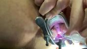 Watch video sex Numbing cervix with local anesthetic fastest