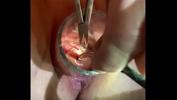 Download video sex new Gyno sound into uterus HD online